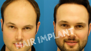 Hair Implant