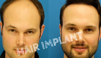 Hair Implant