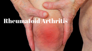 Rheumatoid Arthritis