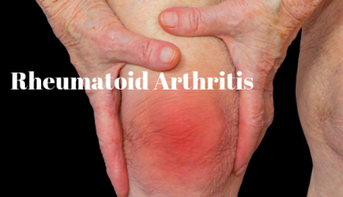Rheumatoid Arthritis