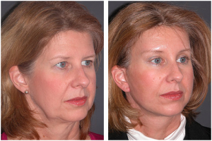 neck facelift
