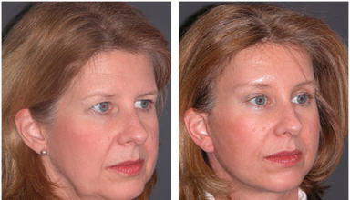 neck facelift