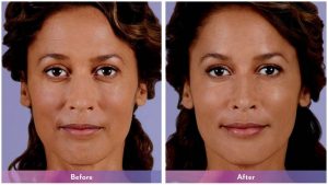 Juvederm