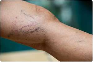 Varicose Veins