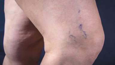 Varicose Veins