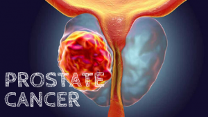 Prostate cancer