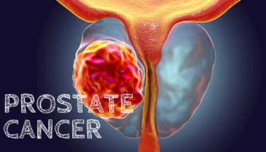Prostate cancer