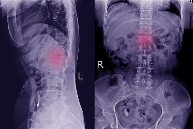 Spondylolisthesis