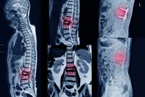 Spondylolisthesis Diagnosis