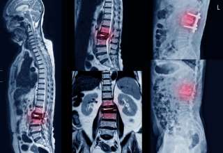 Spondylolisthesis Diagnosis