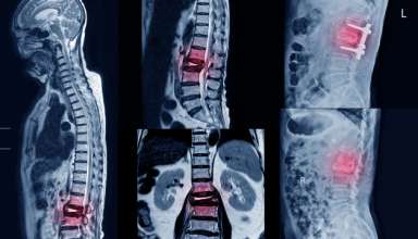 Spondylolisthesis Diagnosis