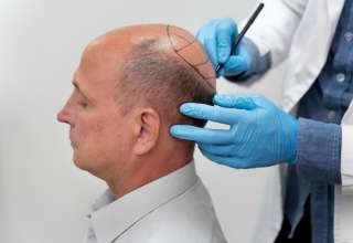 Hair Transplantation