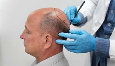 Hair Transplantation