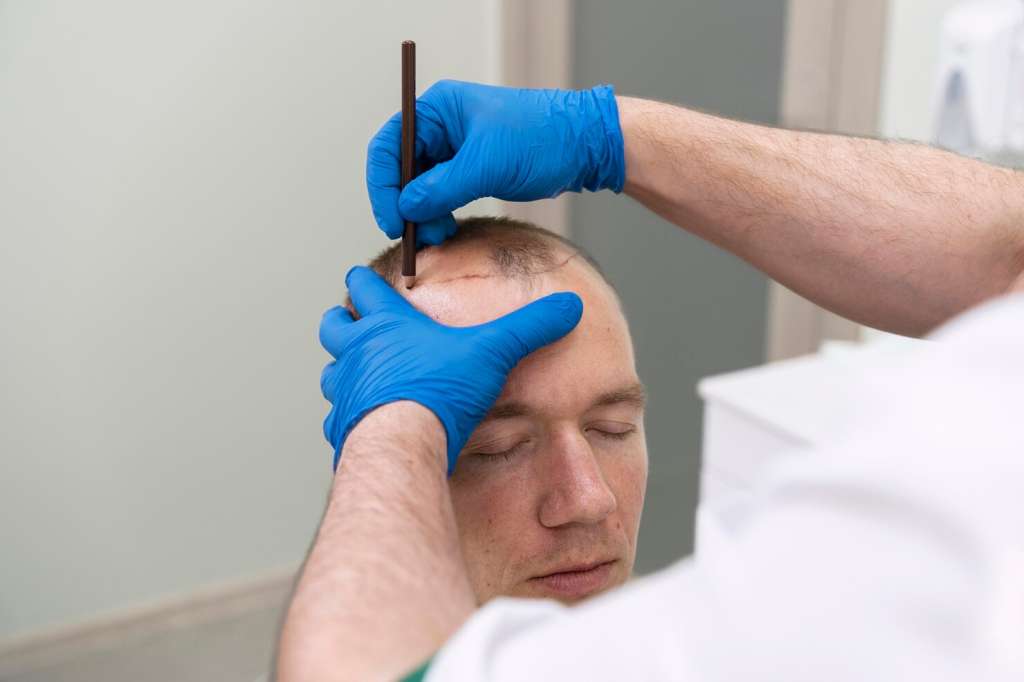 Hair Transplantation